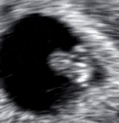 6 haftalık hamile ultrason hafta hafta gebelik